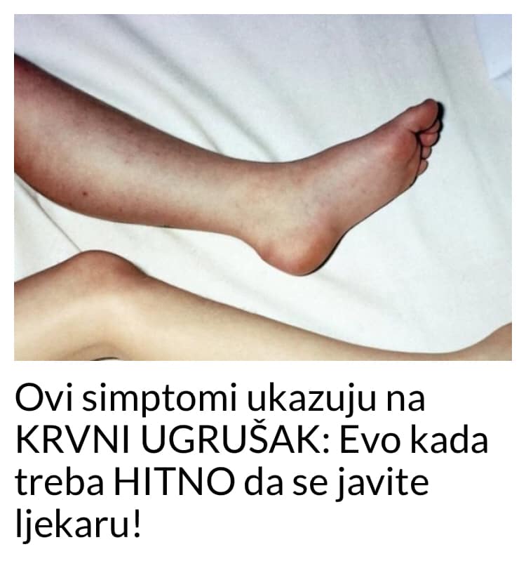 Ovi simptomi ukazuju na KRVNI UGRUŠAK Evo kada treba HITNO da se