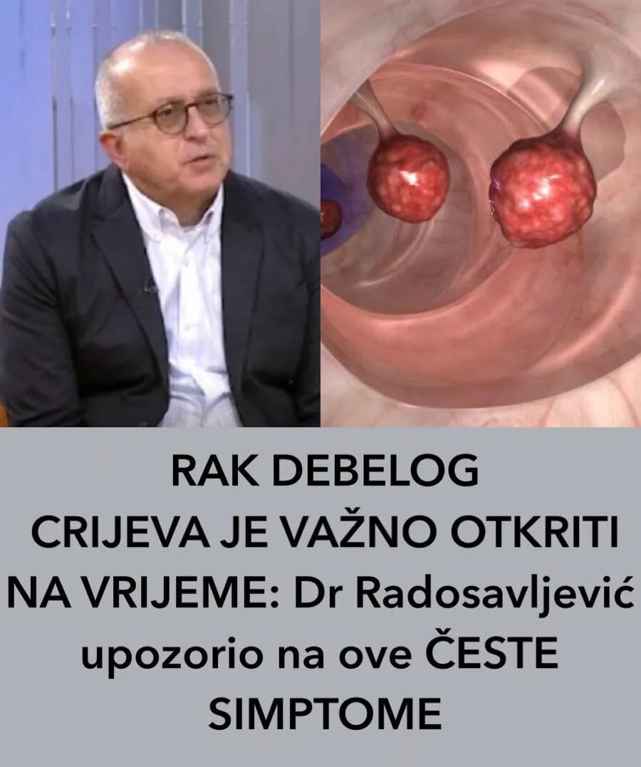 Rak Debelog Crijeva Je Va No Otkriti Na Vrijeme Dr Radosavljevi