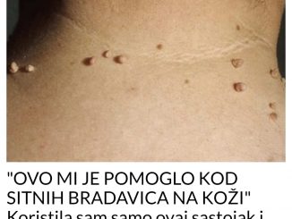 “OVO MI JE POMOGLO KOD SITNIH BRADAVICA NA KOŽI” Koristila sam samo ovaj sastojak i uspjele su nestati (RECEPT)