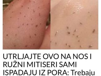 UTRLJAJTE OVO NA NOS I RUŽNI MITISERI SAMI ISPADAJU IZ PORA:  Trebaju vam samo 2 sastojka, a imate ih kući