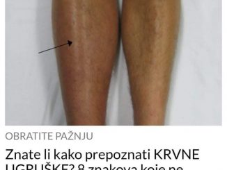 Znate li kako prepoznati KRVNE UGRUŠKE? 8 znakova koje ne smijete ignorisati