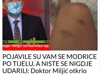 POJAVILE SU VAM SE MODRICE PO TIJELU, A NISTE SE NIGDJE UDARILI:  Doktor Miljić otkrio kad modrice na tijelu znače ozbiljnu bolest