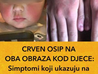 CRVEN OSIP NA 0BA OBRAZA K0D DJECE:  Simptomi Koji Ukazuju Na Petu Bolest, Važno Upozorenje Za Roditelje